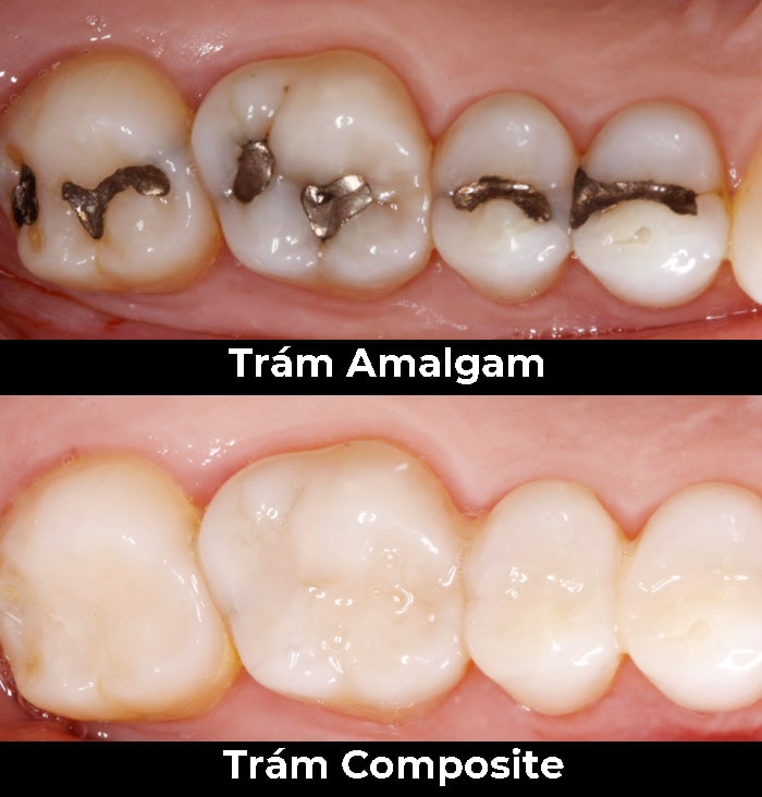 Những vật liệu trám được sử dụng hiện nay