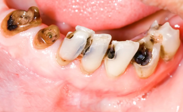 Cách khắc phục khi gặp tình trạng răng bị sâu sau khi trám
