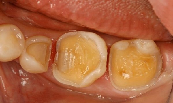 Cách hạn chế tình trạng răng trám rồi bị sâu lại