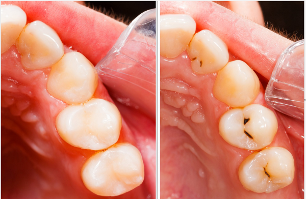 Trám răng rồi có bị sâu lại không?