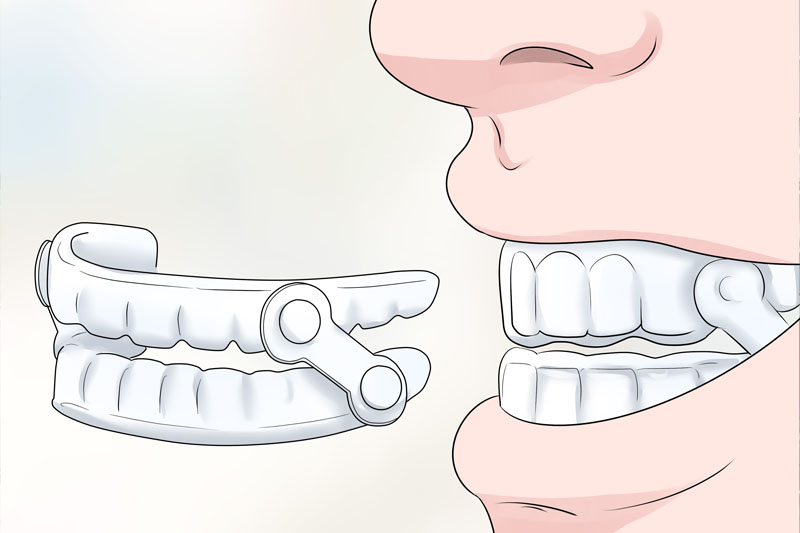 Máng chống nghiến răng là gì?