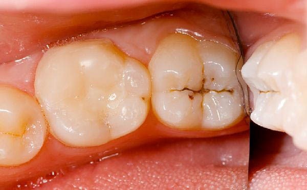 Dấu hiệu nhận biết răng sâu