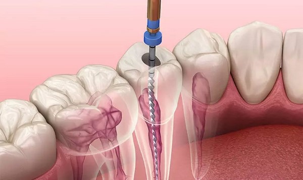 Thời gian lấy chỉ máu răng