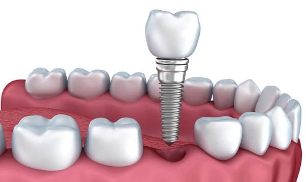 Trồng răng implant