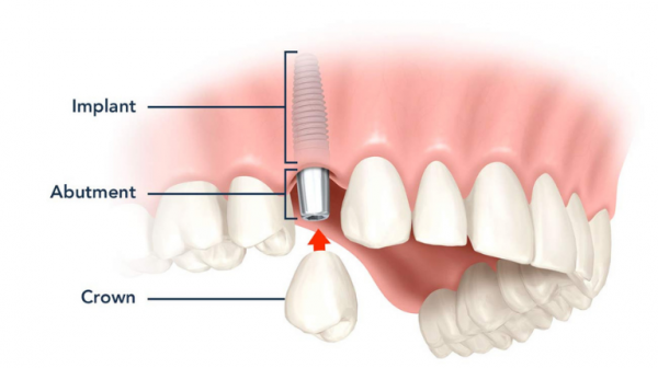 Phương pháp trồng răng khểnh