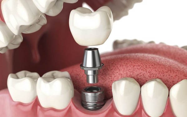 Cấy ghép răng Implant