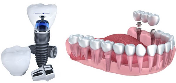 Ưu điểm vượt trội của trồng răng Implant