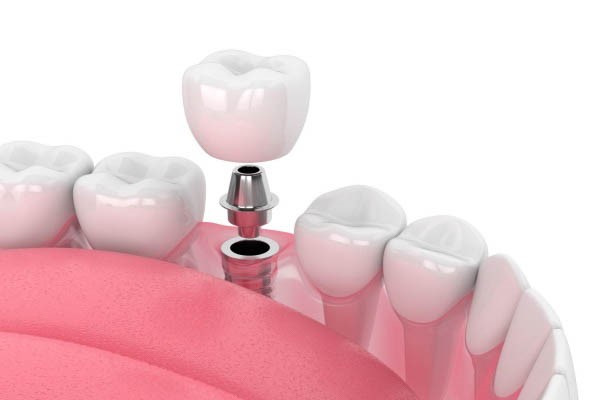 Nhược điểm cần lưu ý khi trồng răng Implant