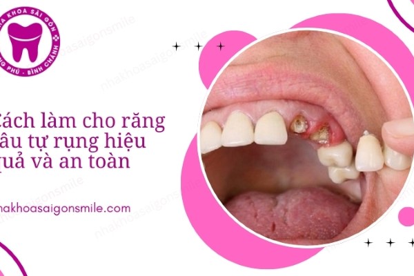 Cách làm cho răng sâu tự rụng​ hiệu quả và an toàn