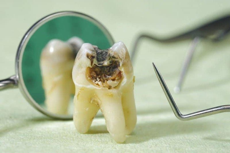 Răng số 7 bị sâu có nên nhổ không?