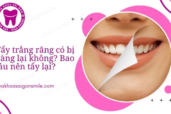 Tẩy trắng răng có bị vàng lại không? Bao lâu nên tẩy lại?