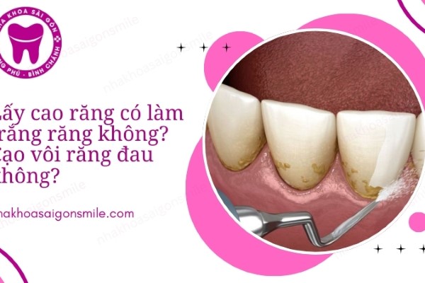 Lấy cao răng có làm trắng răng không? Cạo vôi răng đau không?