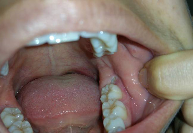 Một số ảnh hưởng đến sức khỏe có thể xảy ra khi nhổ răng số 7 bị sâu