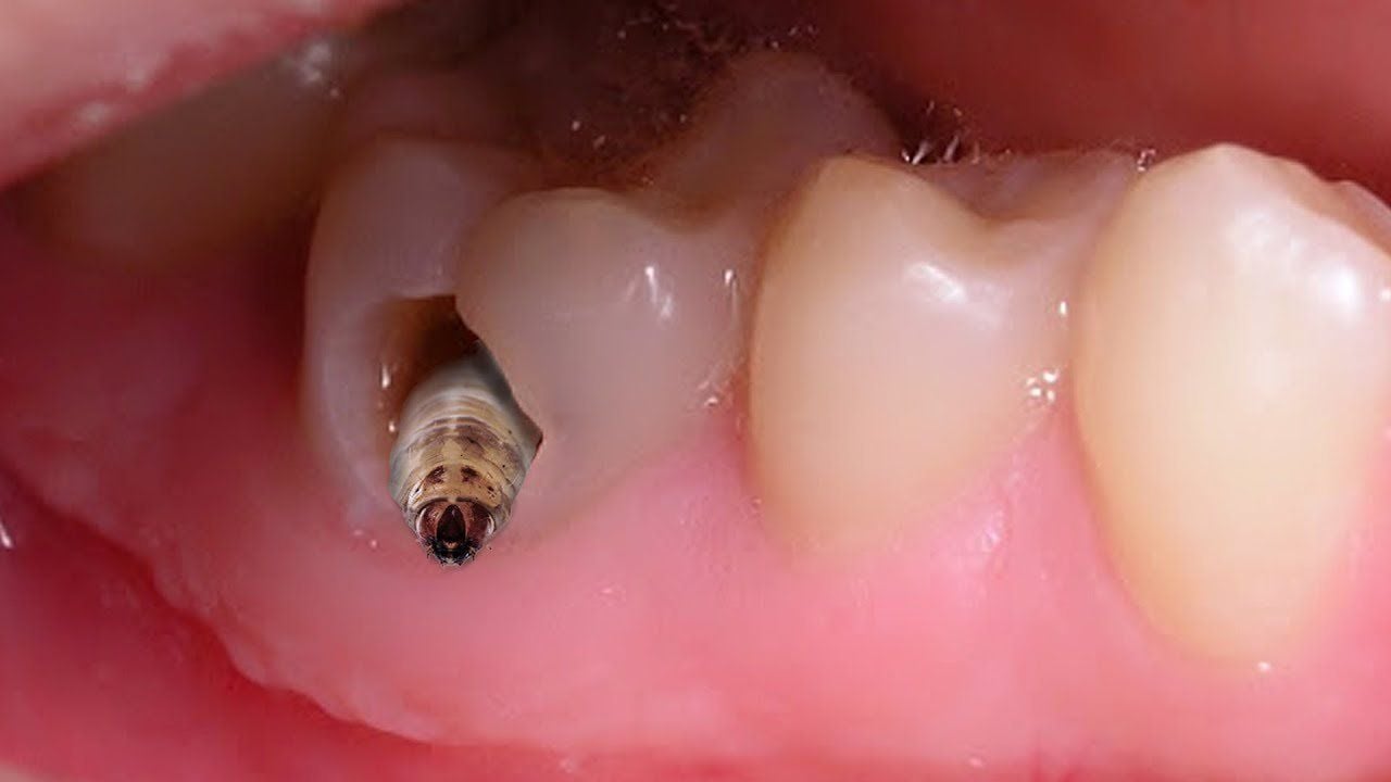 Những nguy cơ gặp phải khi răng bị sâu lỗ to