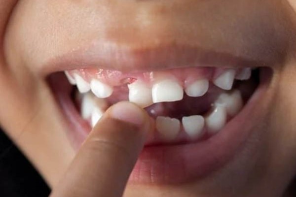 Răng sâu có tự rụng?