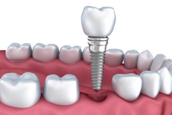 Nhổ răng và trồng răng implant