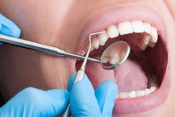 Quy trình loại bỏ cao răng và làm trắng răng