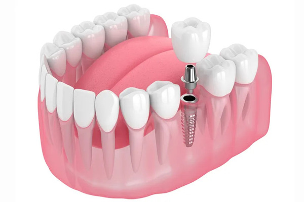 Cấy ghép Implant cho răng cấm đã mất Cấy ghép Implant cho răng cấm đã mất