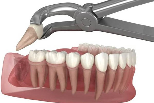 Phương pháp nhổ răng số 8 truyền thống