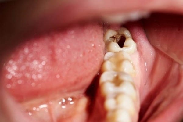 Răng số 8 bị sâu có nên nhổ không?
