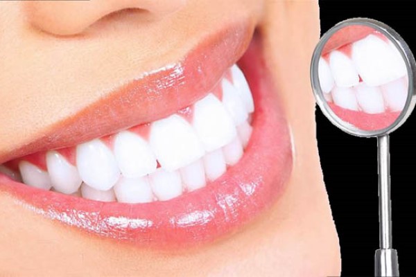 Tẩy trắng răng là gì?