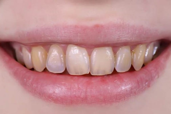 Tẩy trắng răng có thể bị vàng lại