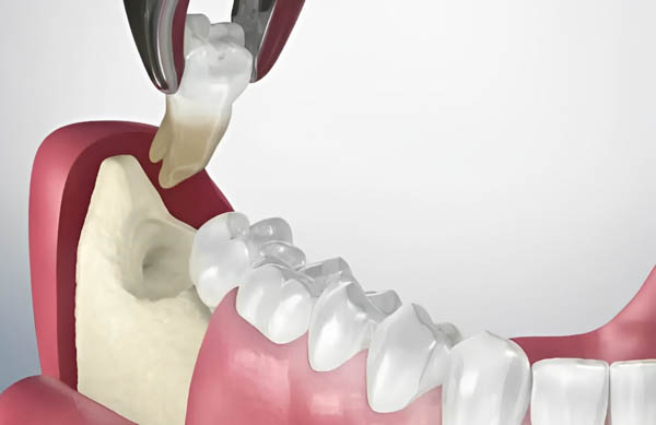 Tổng quan về răng khôn và lý do cần nhổ