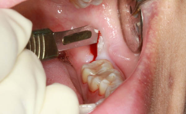 Phẫu thuật răng khôn (Surgical extraction)