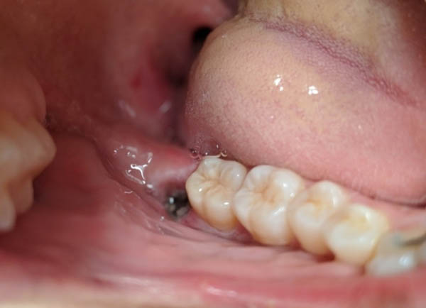 Biến chứng có thể gặp và cách xử lý sau khi nhổ răng khôn