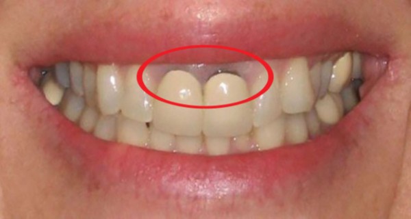 Bọc răng sứ bị đen nướu