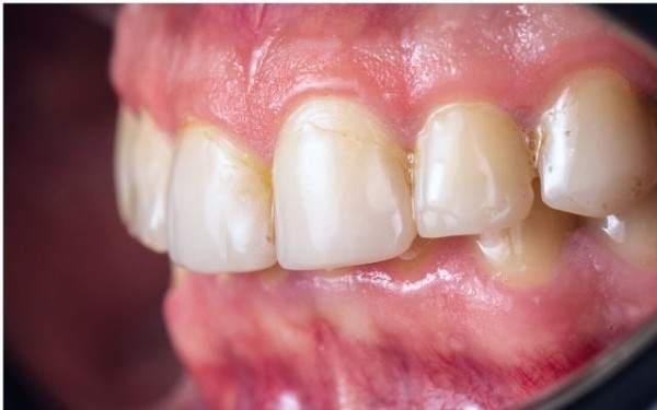 Bị nha chu có bọc răng sứ được không​?