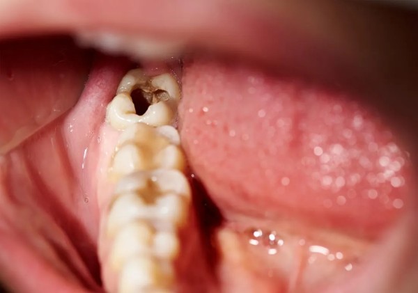Nguyên nhân khiến răng khôn dễ bị sâu