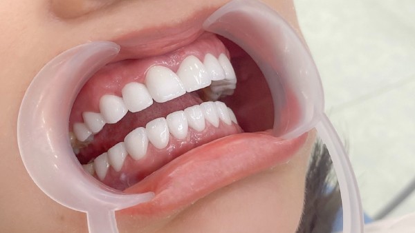 Bọc răng sứ lần 2​ diễn ra như thế nào?
