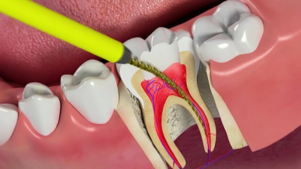 Bọc răng sứ có lấy tủy không​? Ưu nhược điểm và chi phí
