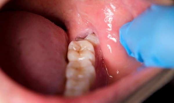 Tại sao cần kiêng một số thực phẩm sau khi nhổ răng khôn?