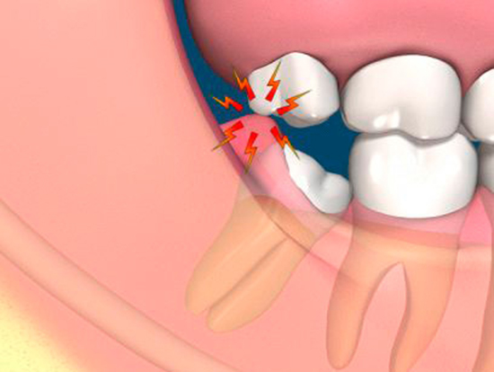Tầm quan trọng của việc ăn uống sau nhổ răng khôn