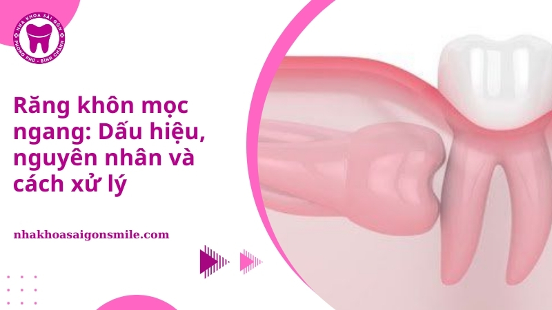 10. Rang khon moc ngang Dau hieu nguyen nhan va cach xu ly
