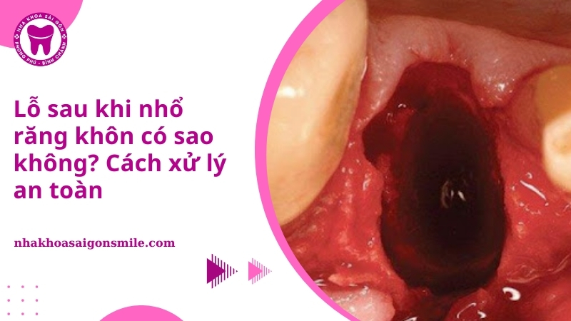 18. Lo sau khi nho rang khon co sao khong Cach xu ly an toan