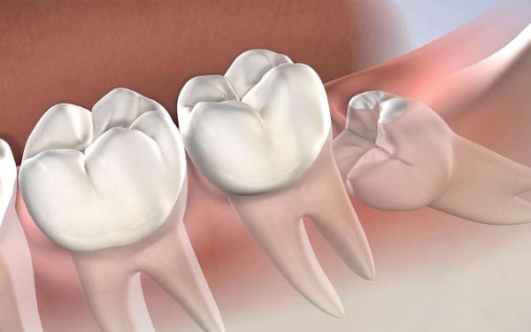 Tổng hợp các cách giảm đau khi mọc răng khôn