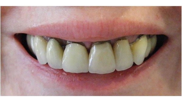 Nguyên nhân chính gây đen nướu khi bọc răng sứ