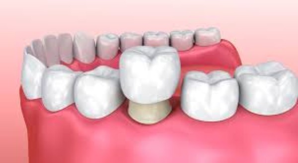 Quy trình tháo mão răng sứ an toàn, chuyên nghiệp
