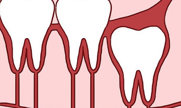 Các trường hợp răng khôn mọc thẳng KHÔNG cần nhổ
