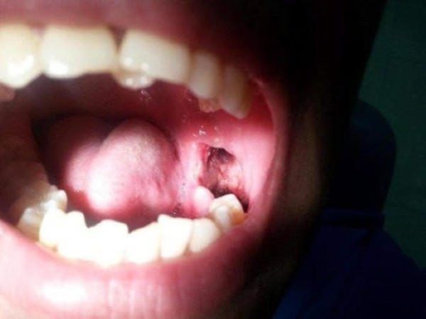 Quá trình lành thương của lỗ sau khi nhổ răng khôn.