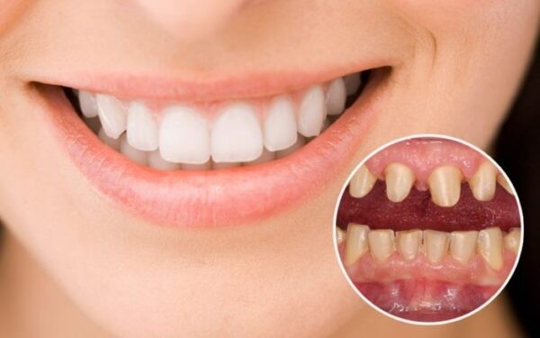 Quy trình bọc răng sứ lần 2 chuẩn y khoa
