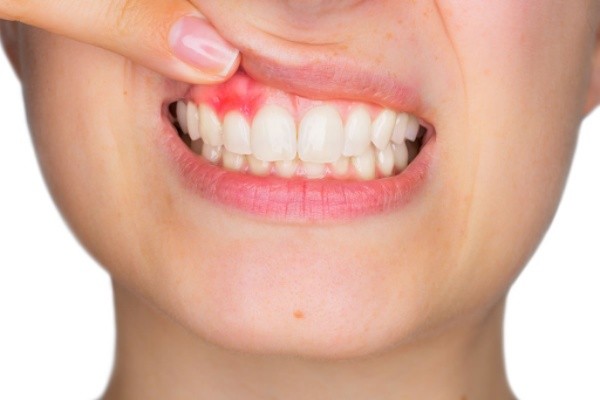 Nguyên nhân dẫn đến bọc răng sứ bị viêm lợi