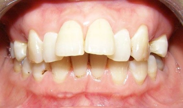 Các yếu tố ảnh hưởng đến chi phí bọc răng sứ cho răng hô