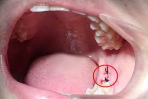 Các mốc thời gian hồi phục và hướng dẫn ăn uống
