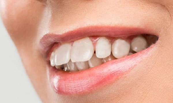 So sánh bọc răng sứ với niềng răng và phẫu thuật hàm