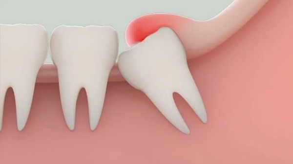 Biểu đồ giá theo loại răng khôn