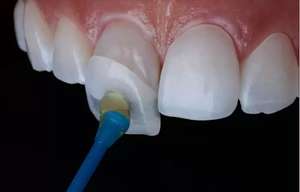 Nguyên nhân gây ra lệch khớp cắn sau bọc răng sứ